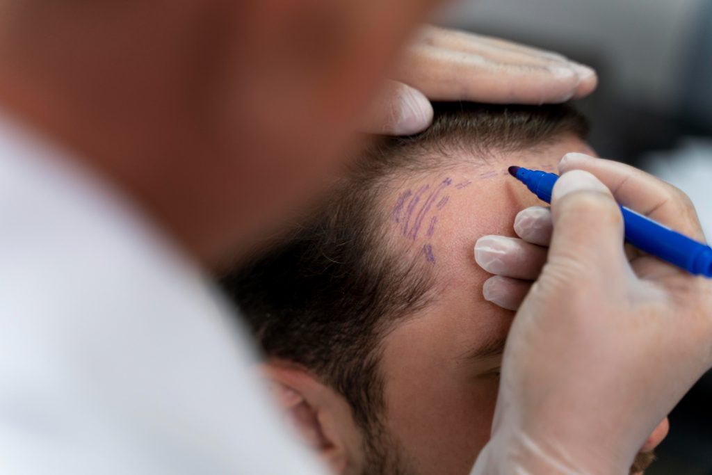 El trasplante capilar, una solución estética cada vez más demandada